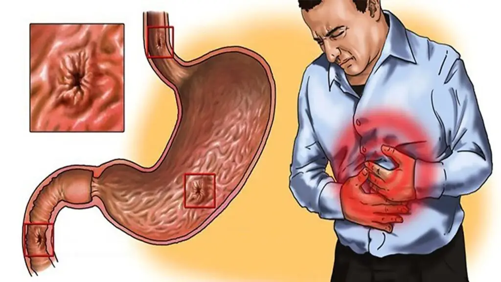 Cause of gastritis and types of gastritis